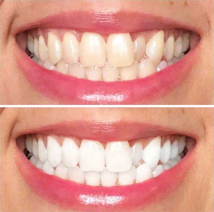 Branqueamento Dentário - Antes/Depois